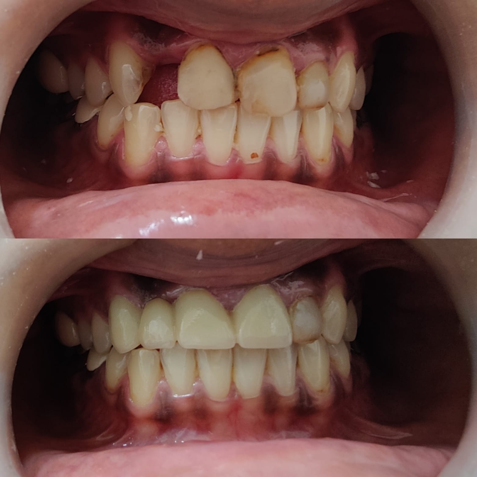 Dental Crown & Bridge Before and After