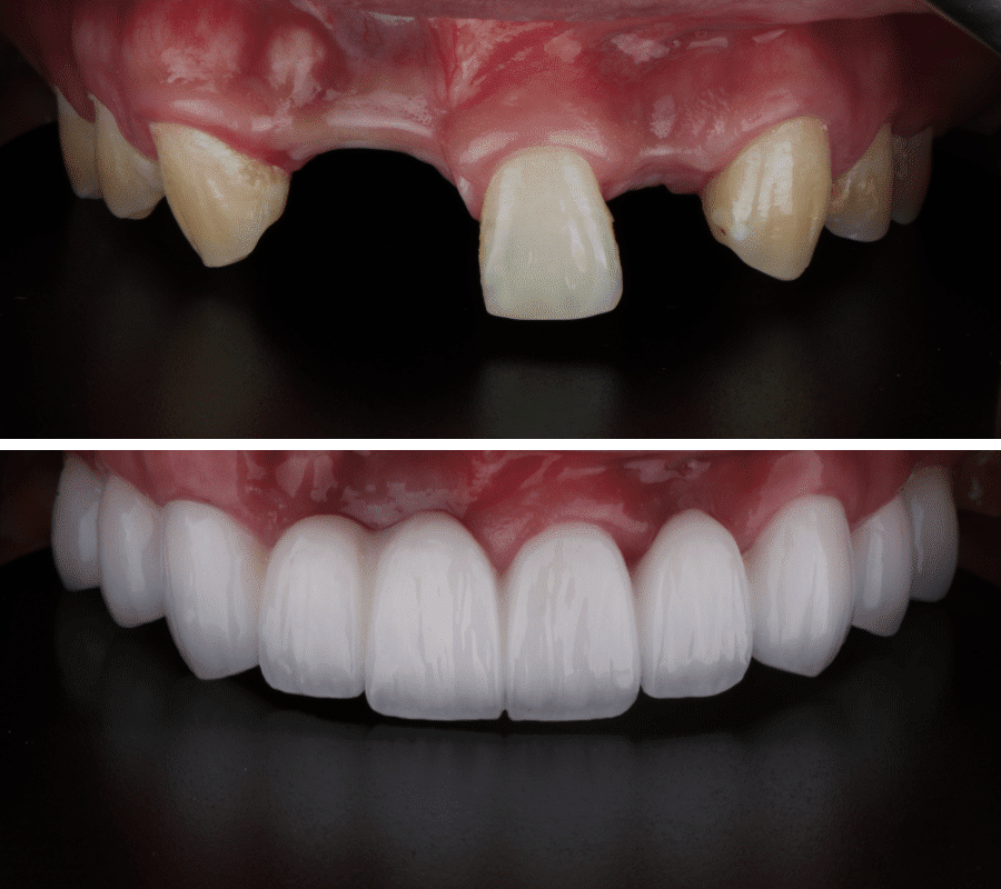 Dental Crown & Bridge Before and After