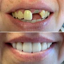 Dental Crown & Bridge Before and After