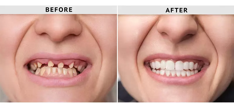 Dental Crown & Bridge Before and After